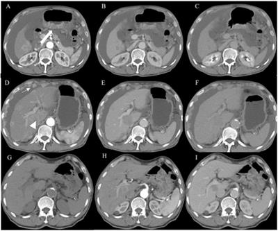 Liver metastasis from hepatoid adenocarcinoma of the stomach: a case report and literature review